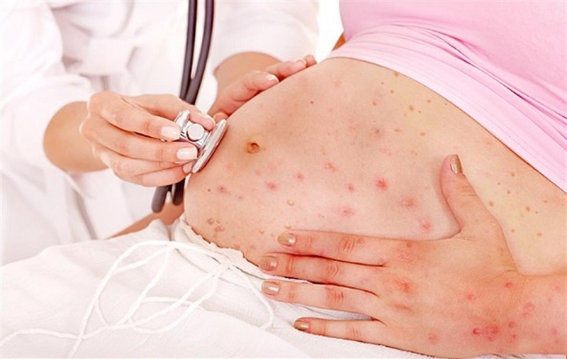 Sốt phát ban là dấu hiệu bệnh rubella khi mang thai. (Ảnh: Sưu tầm Internet)