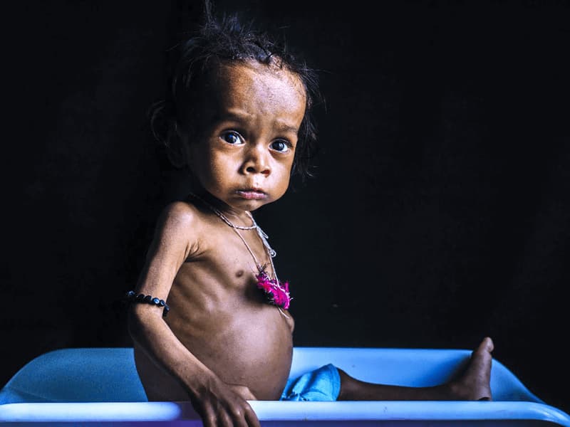 Chế độ dinh dưỡng hằng ngày bị mất cân bằng là nguyên nhân chủ yếu gây ra chứng suy dinh dưỡng thể phù ở trẻ. (Ảnh: Sưu tầm Internet)