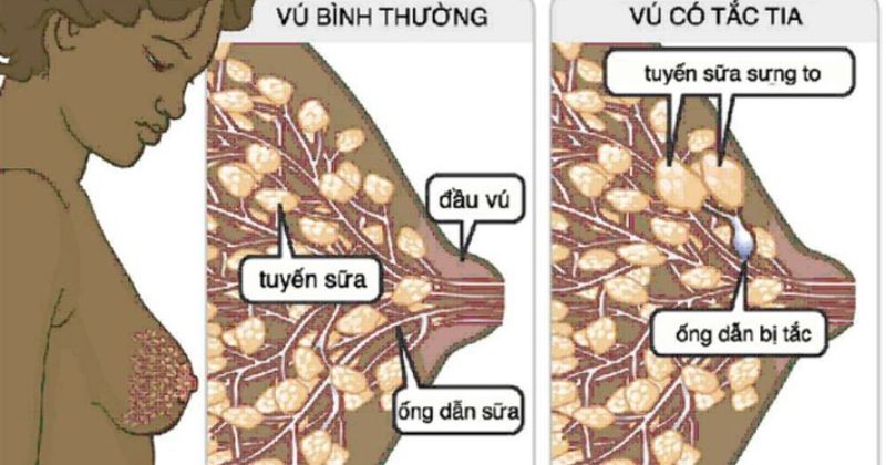 Các mẹ có thể nhận biết tắc sữa thông qua tình trạng ngực bị sưng đau, nóng ran và căng tức (Ảnh: Sưu tầm Internet)