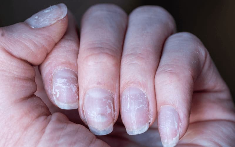 Móng tay bong tróc - dấu hiệu thiếu vitamin B7. (Ảnh: Sưu tầm Internet)
