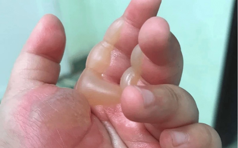 Da bị kích ứng mẩn đỏ, bỏng rát tại vùng tiếp xúc với axit (Ảnh: sưu tầm internet)