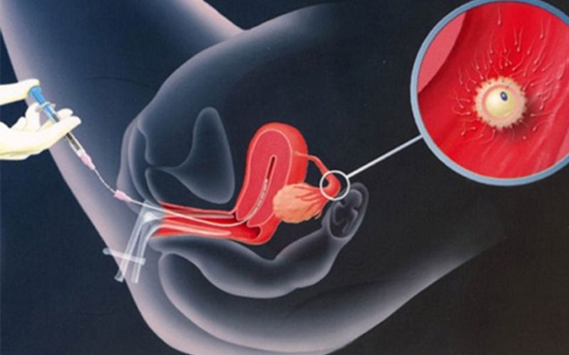 Quá trình chuyển phôi nhân tạo. (Ảnh: Sưu tầm Internet)