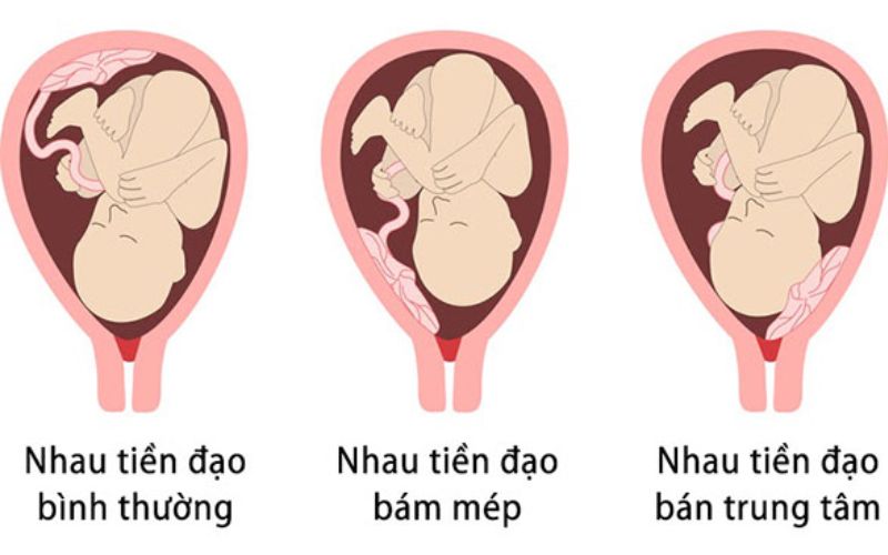 Phân biệt nhau thai bình thường và nhau tiền đạo. (Ảnh: Sưu tầm internet)