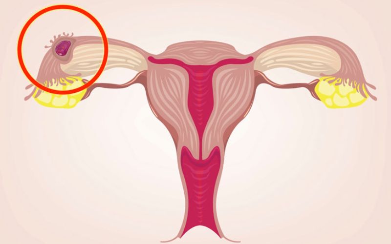 Thai ngoài tử cung có thể gây ra chảy máu âm đạo. (Ảnh: Sưu tầm internet)