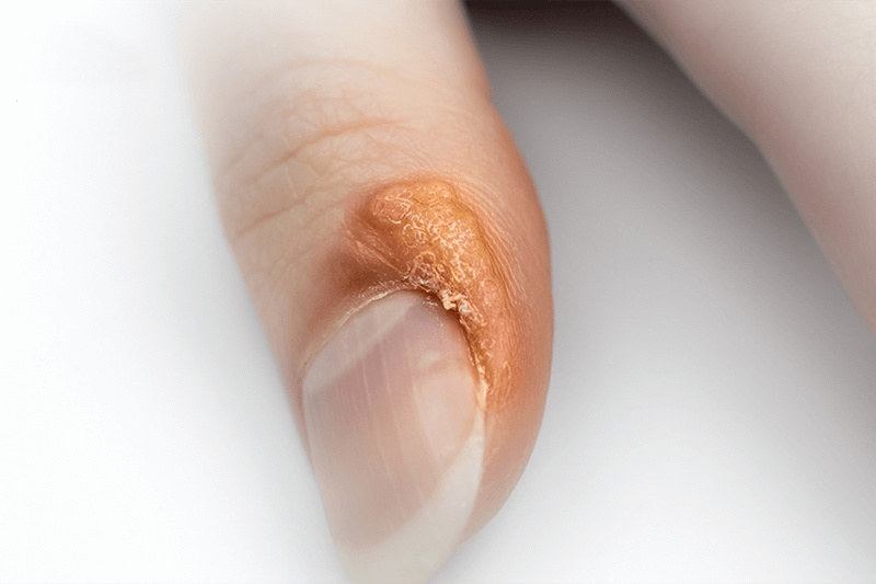 Nhiễm virus móng tay. (Ảnh: Sưu tầm Internet)