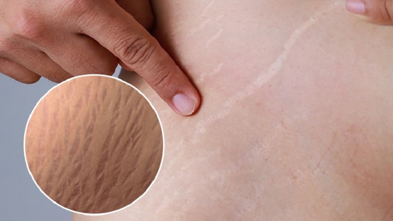 Mẹ có cảm giác ngứa khó chịu do vết rạn đang bắt đầu lên lớp da non mới (Ảnh: Sưu tầm Internet)