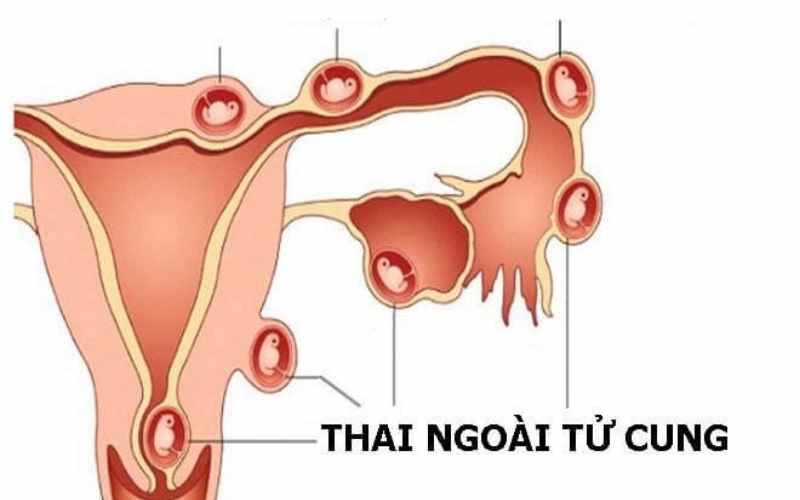 Các vị trí thai ngoài tử cung thường gặp. (Ảnh: Sưu tầm Internet)