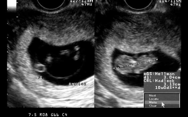 Cần siêu âm để chẩn đoán không có phôi thai. (Ảnh: Sưu tầm Internet)