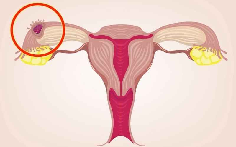 Phôi thai làm tổ ngoài tử cung khiến chảy máu âm đạo. (Ảnh: Sưu tầm Internet)