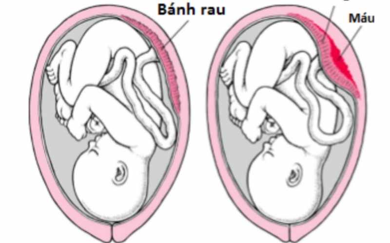 Chảy máu âm đạo cảnh báo mẹ bị nhau bong non. (Ảnh: Sưu tầm Internet)