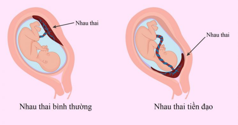 Các hiện tượng nhau thai khi sinh của sản phụ ( Ảnh: Sưu tầm Internet)