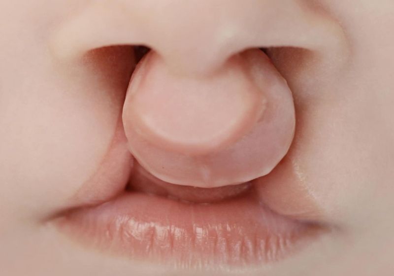 Trẻ bị dị tật sứt môi, hở hàm ếch cả hai bên. (Ảnh: Sưu tầm Internet)