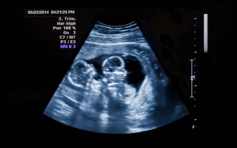 Thai đôi thường bị nhẹ cân hơn tiêu chuẩn. (Ảnh: Sưu tầm Internet)