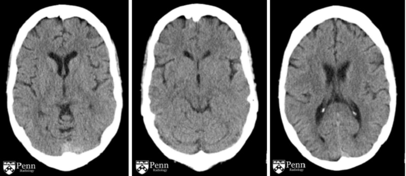 Hình ảnh não bộ khi mắc phải hội chứng Wernicke - Korsakoff. (Ảnh: Sưu tầm Internet)