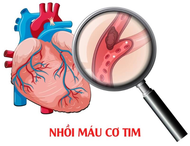 Nhồi máu cơ tim. (Ảnh: Sưu tầm Internet)