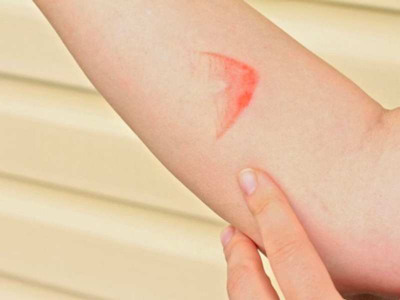 Bị bỏng cấp độ 1 có những biểu hiện như thế nào (Ảnh: Sưu tầm internet)