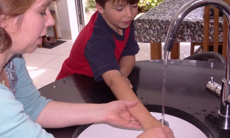 Làm dịu vết bỏng bằng cách rửa dưới vòi nước sạch. (Ảnh: Nguồn Internet)