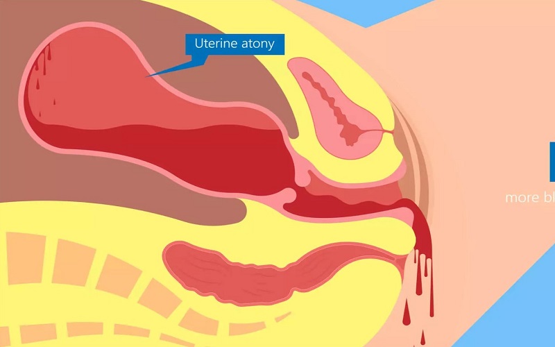 Điều trị trực tiếp bằng cách xoa đáy tử cung, dùng thuốc co tử cung (Ảnh: Sưu tầm Internet)