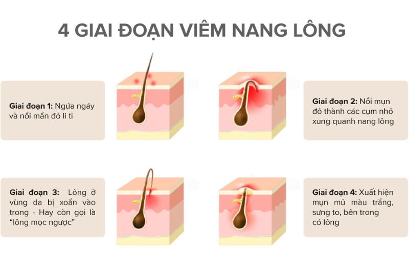 Các giai đoạn viêm nang lông ở bà bầu. (Ảnh: Sưu tầm internet)