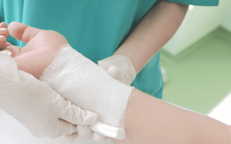 Quấn quanh khu vực bị bỏng bằng gạc vô trùng sau khi rửa sạch vết thương (Ảnh: sưu tầm internet)