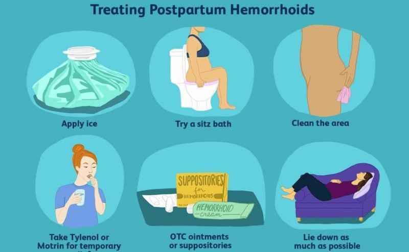 Một số phương pháp giúp điều trị và ngăn ngừa bệnh trĩ trở nặng. (Ảnh: Sưu tầm Internet)