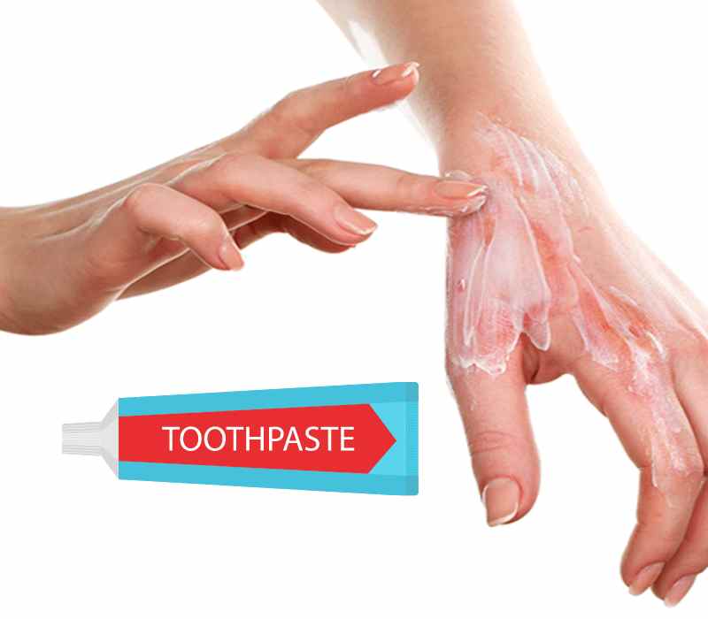 Tuyệt đối không bôi kem đánh răng lên vùng da bị bỏng (Ảnh: Sưu tầm internet)