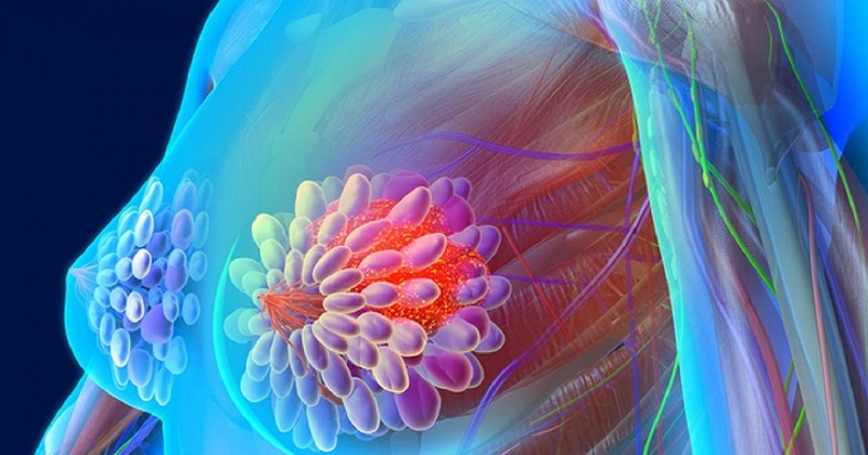 Viêm vú là tình trạng các mô vú của mẹ bị viêm hoặc sưng (Ảnh: Sưu tầm Internet)