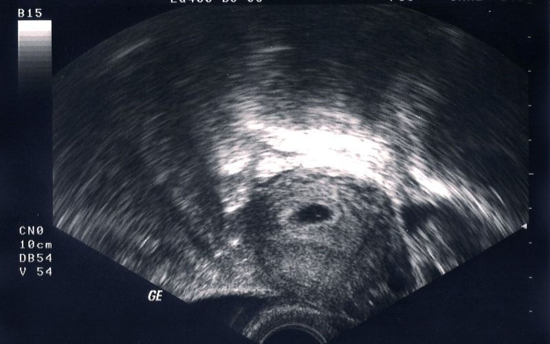 Hút thai trong tháng đầu tiên của thai kỳ. (Ảnh: Sưu tầm Internet)