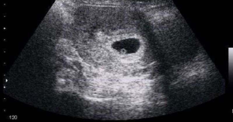 Khoảng từ 7 - 10 tuần là thời gian tốt nhất mẹ có thể siêu âm và xác định việc mang thai  (Ảnh: Sưu tầm Internet)