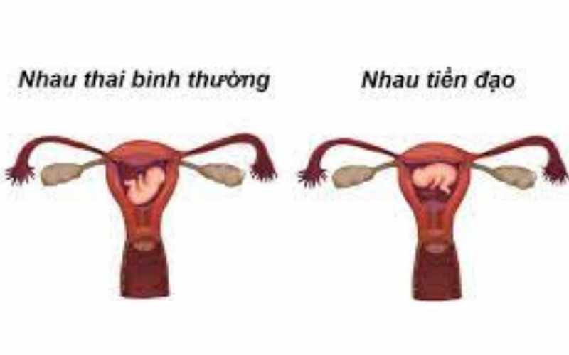Nhau tiền đạo khiến mẹ mang thai 26 tuần bị ra máu. (Ảnh: Sưu tầm Internet)