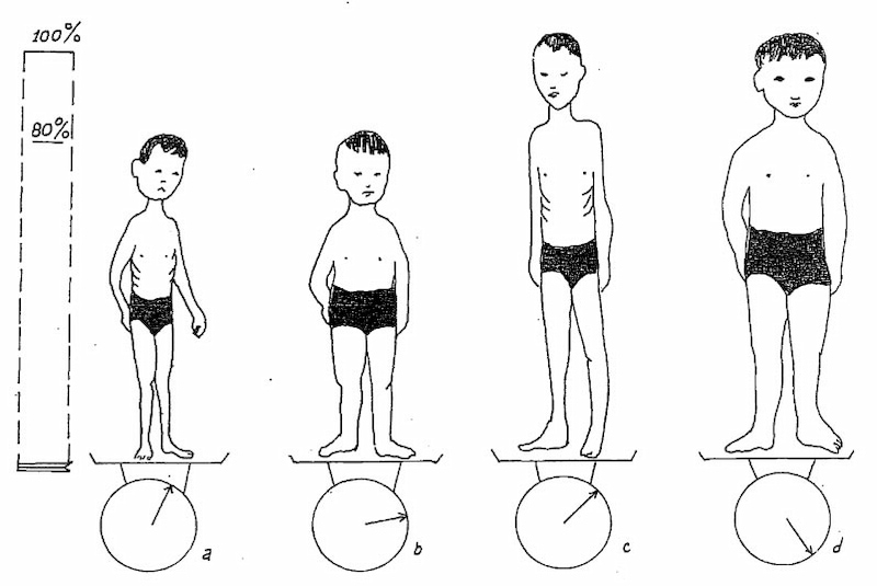 Các loại suy dinh dưỡng ở trẻ 8 tuổi. (Ảnh: Sưu tầm Internet)