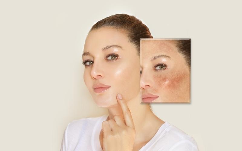 Da mặt sạm do biến đổi nội tiết tố. (Ảnh: Sưu tầm Internet)