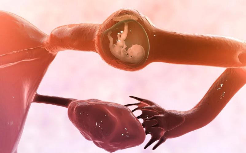 Hình ảnh minh họa về mang thai ngoài tử cung. (Ảnh: Sưu tầm Internet)