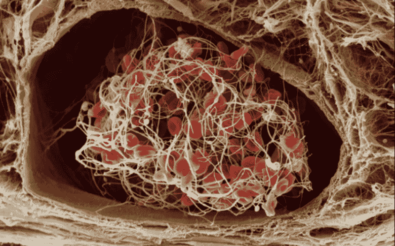 Sốc bỏng có khả năng làm giảm 40% máu lưu thông trong cơ thể (Ảnh: Vinmec)