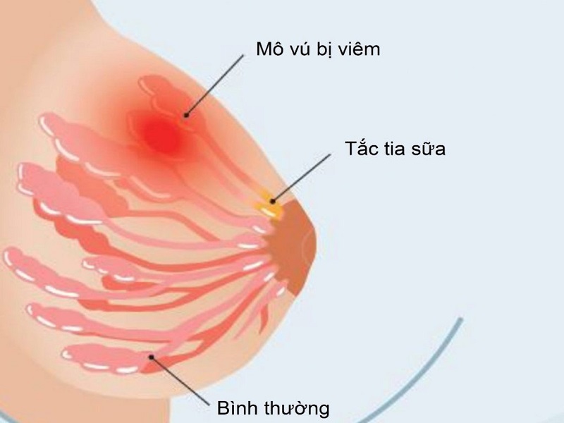 Áp xe vú là hiện tượng vú bị nhiễm trùng, xuất hiện hạch (Ảnh: Sưu tầm Internet)