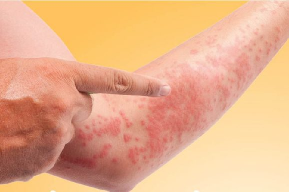 Khi các mẹ sử dụng paracetamol mà có các triệu chứng của tác dụng phụ thì nên ngừng thuốc và đi khám bác sĩ ngay để xử lý và chữa trị kịp thời (Ảnh: Sưu tầm Internet)