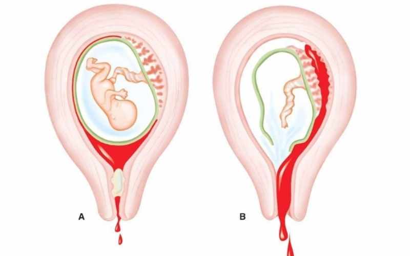 Vỡ tử cung khiến mẹ bị ra máu và có thể gặp nguy hiểm. (Ảnh: Sưu tầm Internet)
