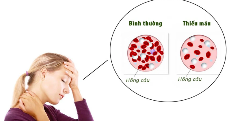 Sau khi bị băng huyết thì các mẹ thường bị thiếu máu trầm trọng ( Ảnh: Sưu tầm Internet)