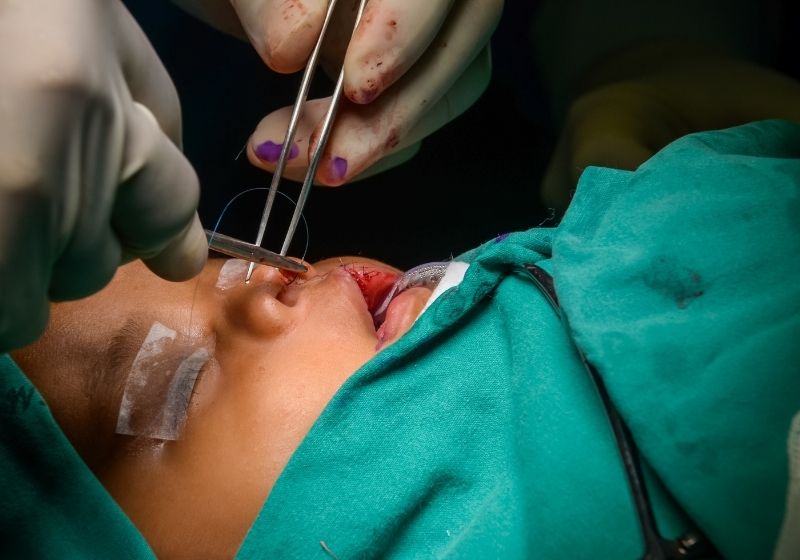 Phẫu thuật chỉnh hình khắc phục dị tật hở hàm ếch cho trẻ. (Ảnh: Sưu tầm Internet)