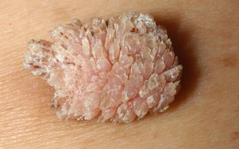 Nên điều trị bệnh sùi mào gà trước khi mang thai. (Ảnh: Sưu tầm Internet)