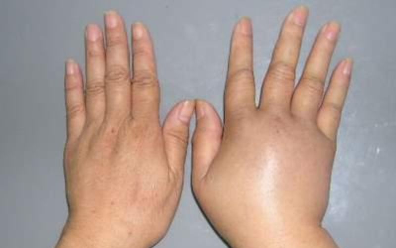 Phù lên tay và mặt là dấu hiệu mẹ cần đi khám. (Ảnh: Sưu tầm Internet)
