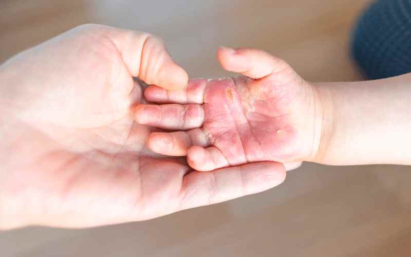 Điều trị vết bỏng ngay lập tức nếu không muốn để lại biến chứng (Ảnh: Sưu tầm internet)