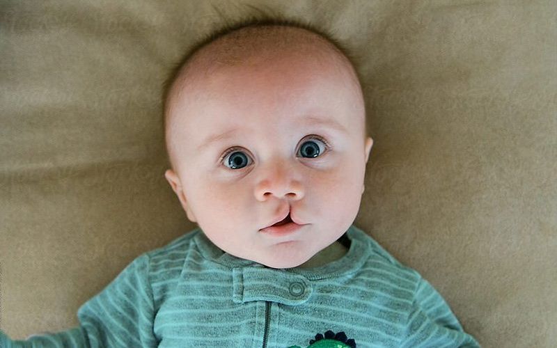 Thai nhi bị dị tật down (Ảnh: Sưu tầm Internet)