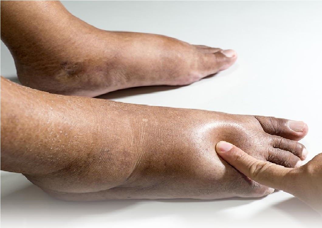 Hiện tượng chân bị sưng phù. (Ảnh: Sưu tầm Internet)