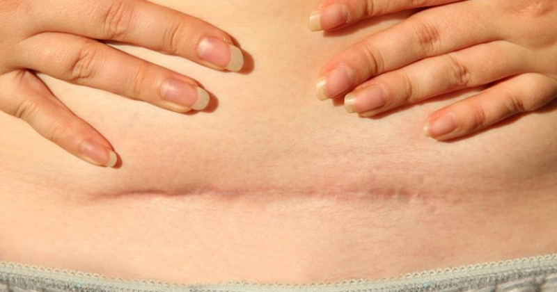 Ăn bầu còn giúp các mẹ bỉm xóa mờ các vết sẹo mổ (Ảnh: Sưu tầm Internet)