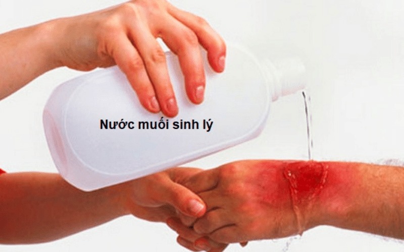 Chọn dung dịch sát khuẩn phù hợp để vết bỏng không bị trở nên nặng hơn (Ảnh: Sưu tầm internet)
