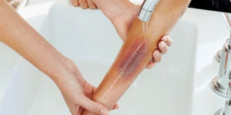 Bỏng điện cấp độ 1 có những biểu hiện nào (Ảnh: sưu tầm Internet)