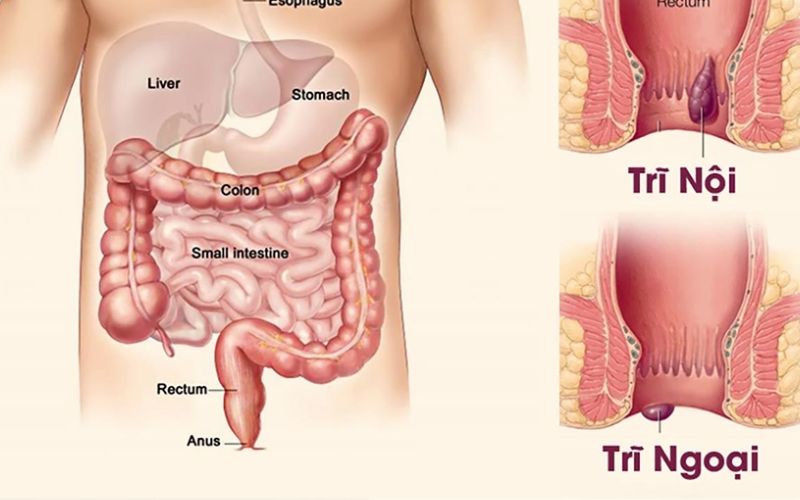 Phụ nữ mắc bệnh trĩ sẽ dễ bị ngứa vùng kín. (Ảnh: Sưu tầm internet)