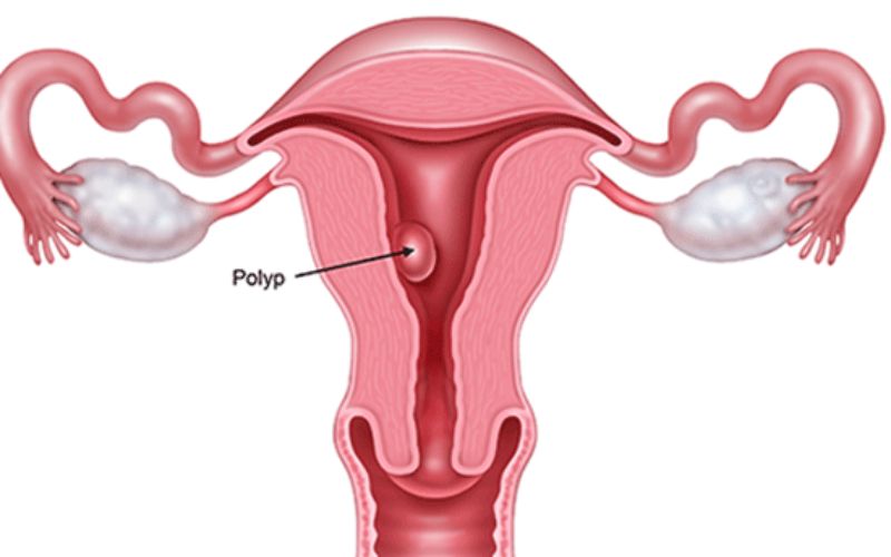Polyp là bệnh lý thường gặp ở phụ nữ. (Ảnh: Sưu tầm internet)