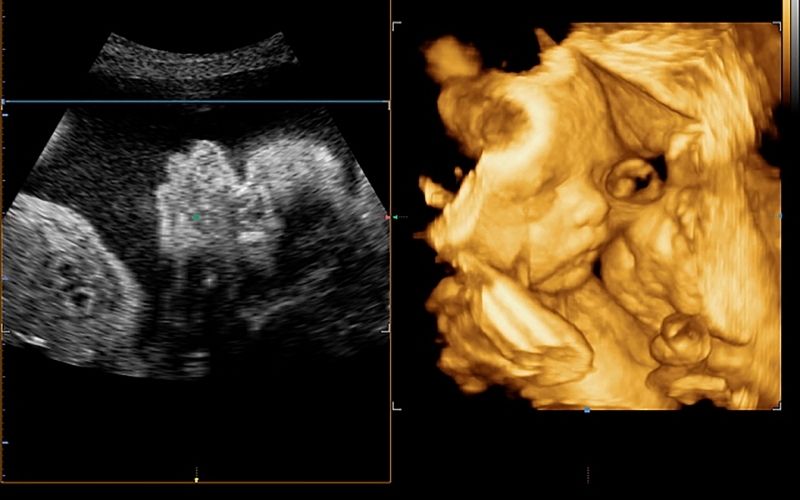 Thai nhi bị ảnh hưởng xấu nếu chỉ số tiểu đường thai kỳ cao. (Ảnh: Sưu tầm Internet)